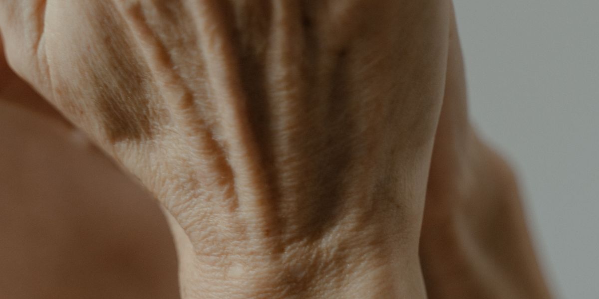 Dupuytren-Kontraktur bei Frauen: Der Gipfel liegt zwischen 50 und 59, der Zusammenhang mit den Wechseljahren aber nicht